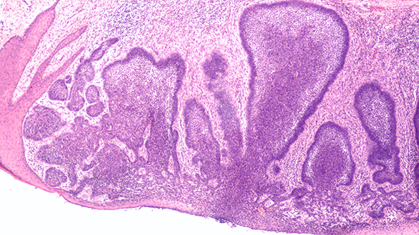 bcc nccn guidelines