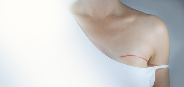 risk-reducing mastectomy